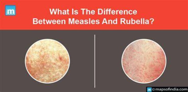 What is the Difference Between Measles and Rubella
