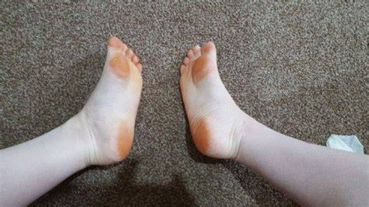 Why are my feet orange
